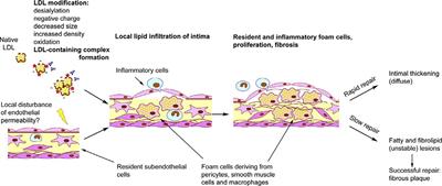 Cellular Mechanisms of Human Atherogenesis: Focus on Chronification of Inflammation and Mitochondrial Mutations